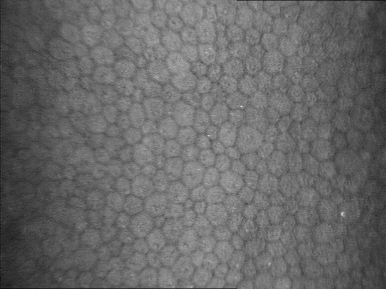 Anomalies endothéliales